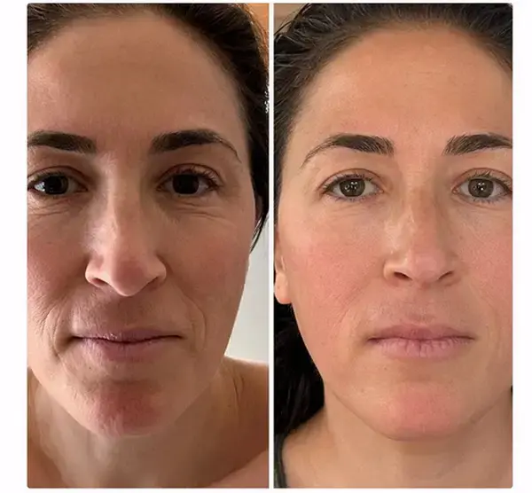 Before and after - Sculptural Face Lifting