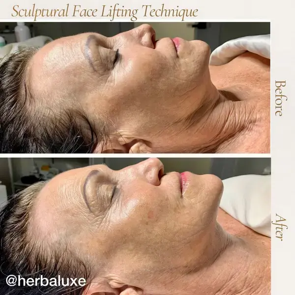 Before and after - Sculptural Face Lifting