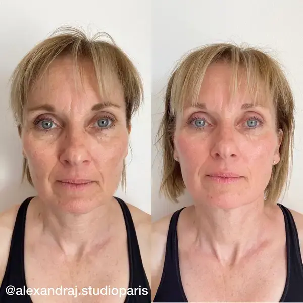 Before and after - Sculptural Face Lifting
