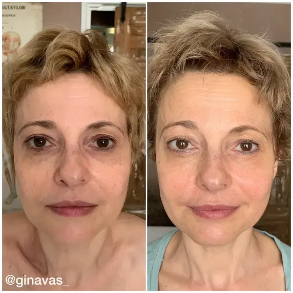 Before and after - Sculptural Face Lifting